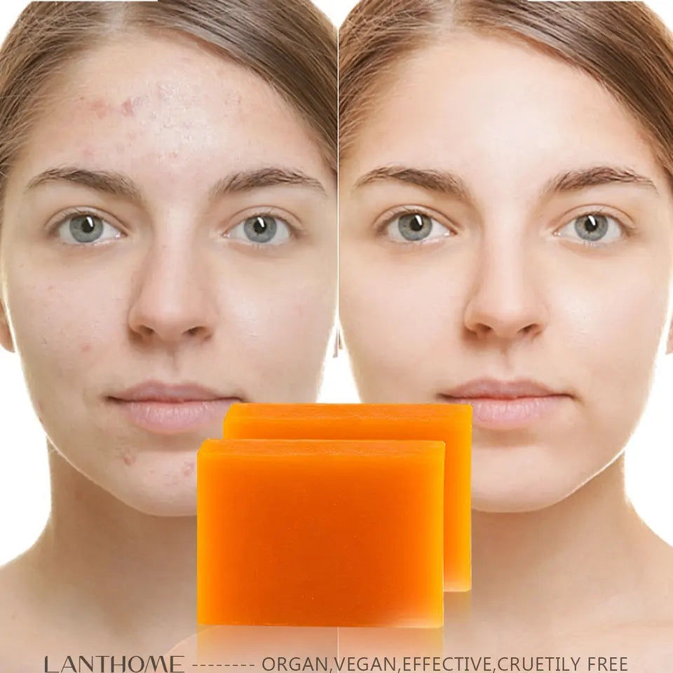 Savon anti dépigmentation KOJIC ACID