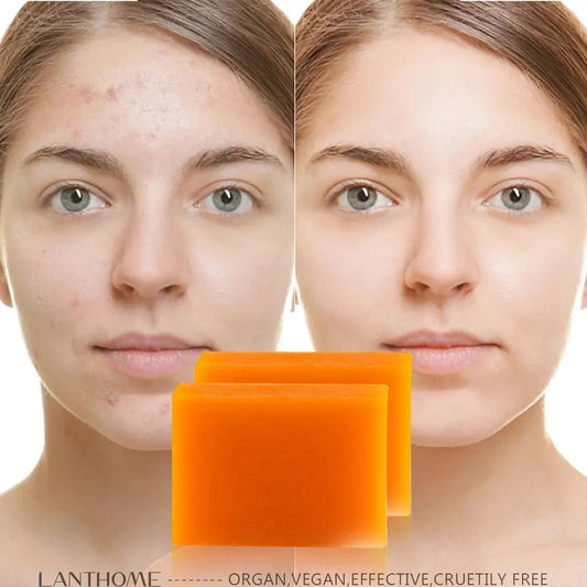 Savon anti dépigmentation KOJIC ACID